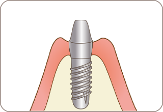 STEP4  二次オペ