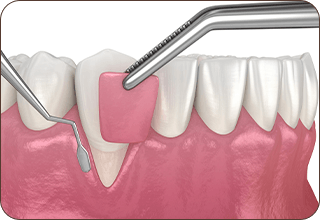 STEP5  歯周外科・再生治療